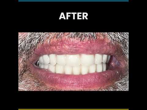 Missing Teeth Replaced